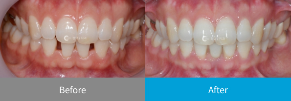 치아 교정 전후 사례