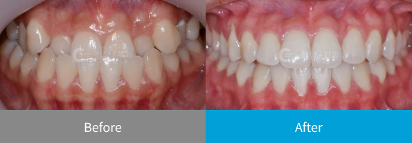 치아 교정 전후 사례