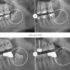 🦷
청담i치과는 대학병원으로 의뢰 된 매복 사랑니 발치도 가능합니다.

📞 더 궁금하신 점 있으시면 전화부탁드립니다.

☑️예약 및 문의☑️
전화상담 031-837-1111 
홈페이지 cdios.co.kr 
카톡상담 pf.kakao.com/_dPkCl 
네이버예약 https://bit.ly/2ZTEjrD
# 월수목 6시
# 화금 9시 (야간진료)
# 토 5시
# 1시~2시 점심시간