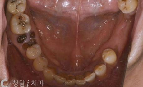 시술전 사진