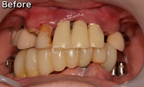 전악 임플란트 (다른 치과 임플란트 재 보철)