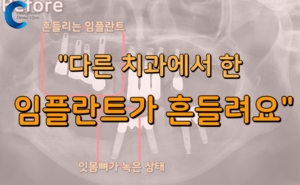 “다른 치과에서 한 임플란트가 흔들려요”