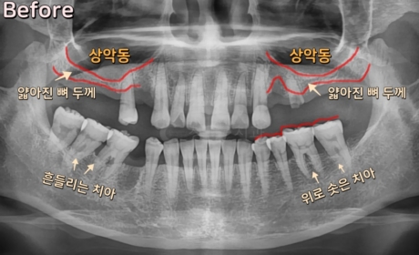 시술전 사진