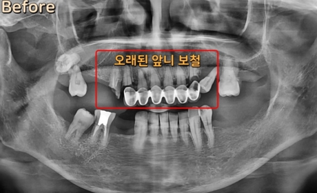 시술전 사진