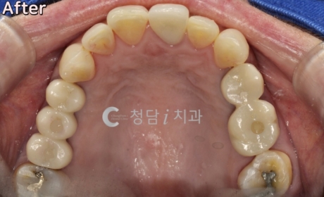 시술후 사진