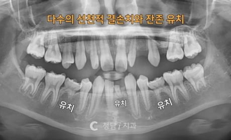 시술전 사진
