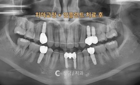 시술후 사진