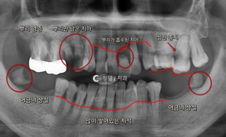 시술전 사진