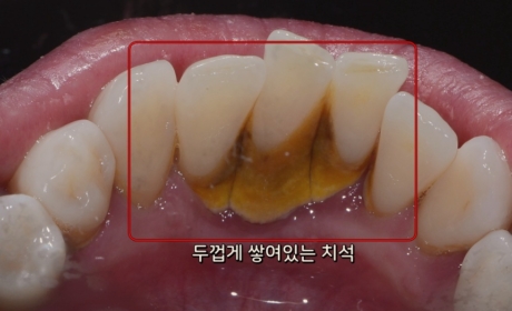 시술전 사진