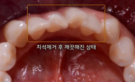 시술후 사진