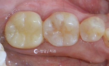 시술후 사진