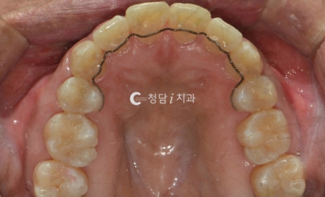 시술후 사진