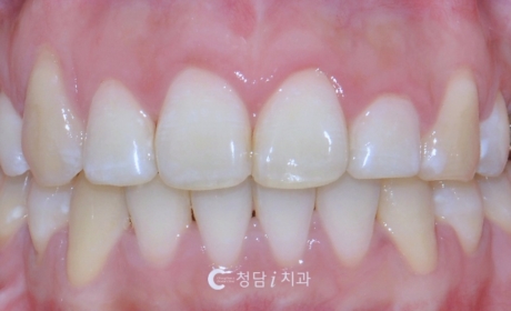 시술후 사진