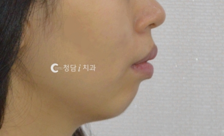 시술전 사진