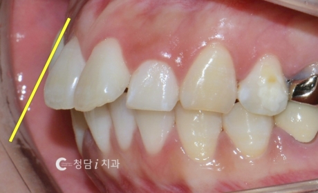 시술전 사진