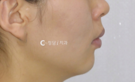 시술후 사진