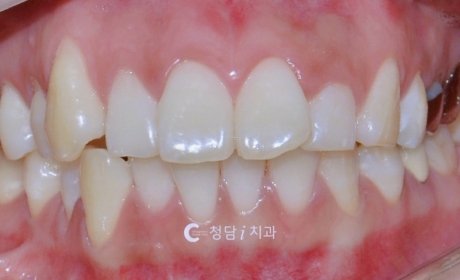 시술전 사진