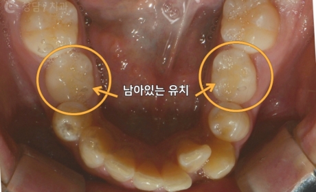 시술전 사진