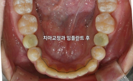 시술후 사진