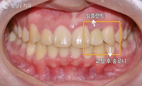시술후 사진