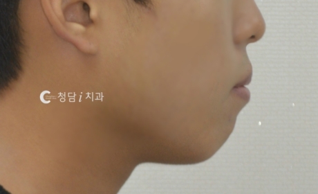 시술전 사진