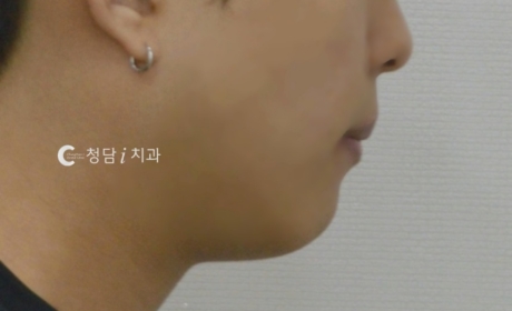 시술후 사진