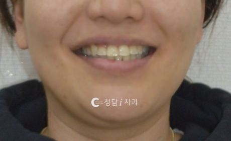 시술후 사진