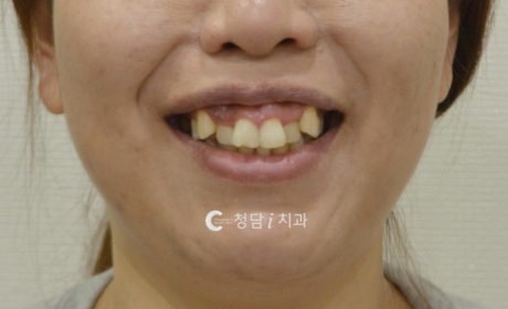 시술전 사진