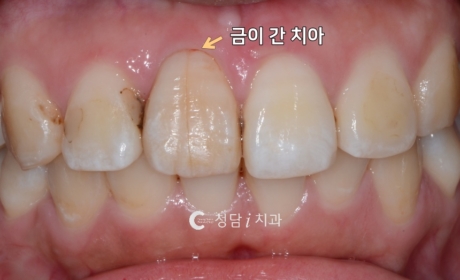 시술전 사진