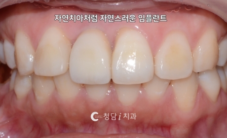 시술후 사진