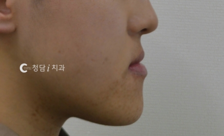 시술전 사진