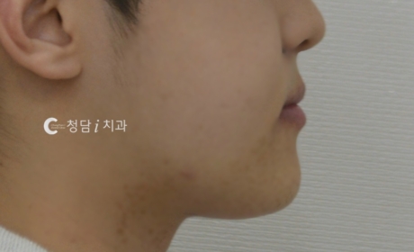 시술후 사진
