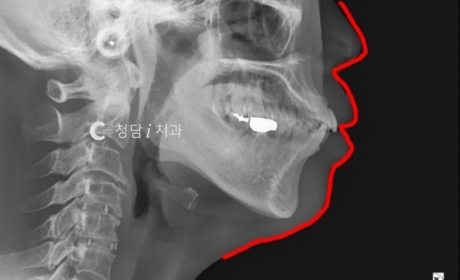 시술전 사진