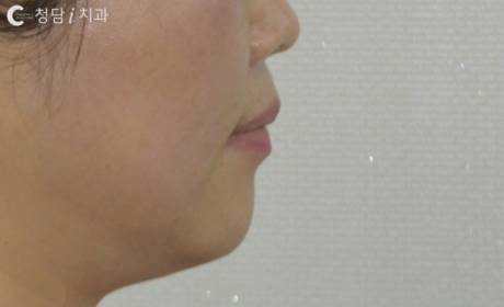 시술후 사진