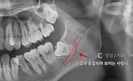 시술전 사진