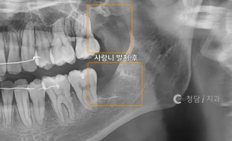 시술후 사진