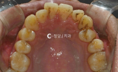 시술전 사진