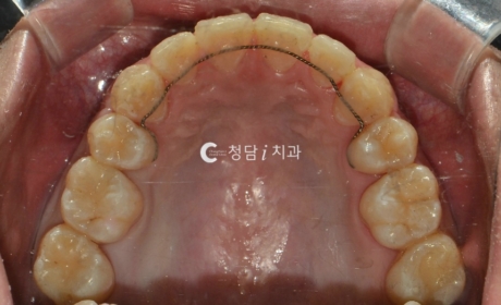 시술후 사진