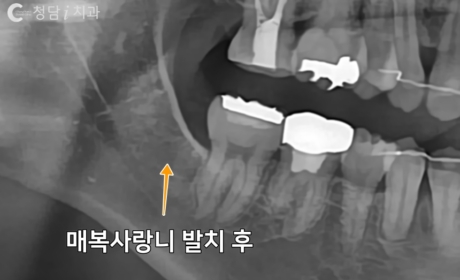 시술후 사진