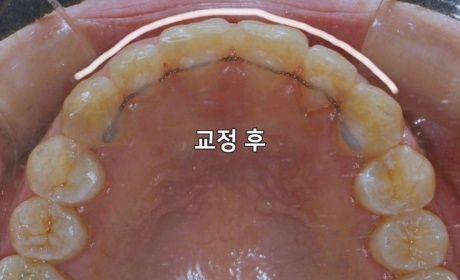 시술후 사진