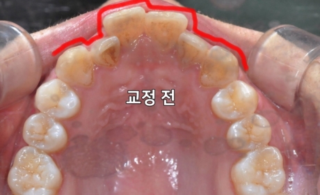 시술전 사진