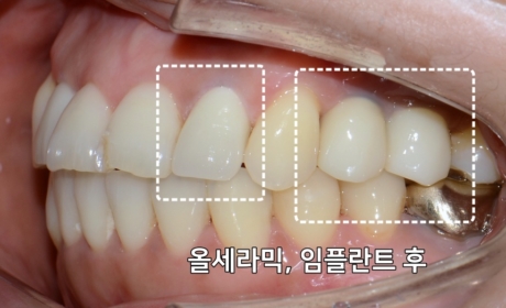 시술후 사진