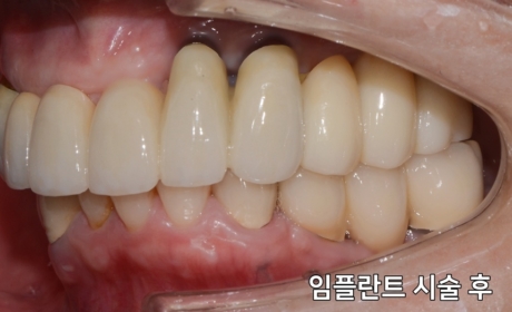 시술후 사진