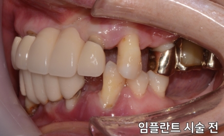 시술전 사진