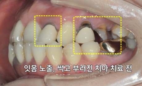 시술전 사진